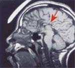 fetal alcohol syndrome child brain scan