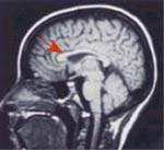 normal child brain scan