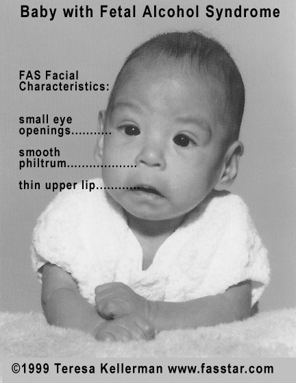 fetal alcohol syndrome. Baby with Fetal Alcohol
